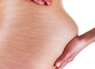 Cum scapam de vergeturi