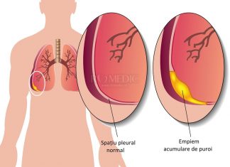 Ce sunt revarsatele lichidiene pleurale?