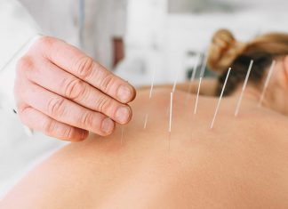 Top 6 beneficii ale acupuncturii pentru stresul si durerea la locul de munca