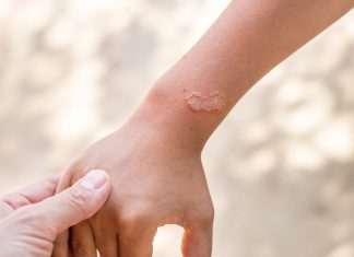 Cele mai bune 9 remedii naturale pentru eliminarea ciupercilor de pe piele